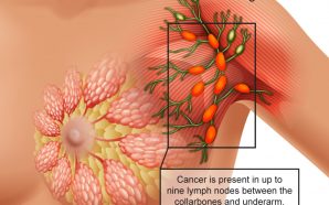 Stages of Breast Cancer