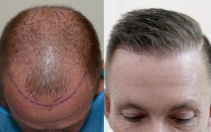 HAIR TRANSPLANT