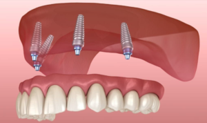 Multiple Teeth Replacement in Fort Worth: The Natural Solution You Need